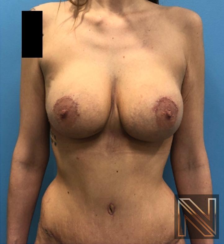 Abdominoplasty: Patient 31 - After 1