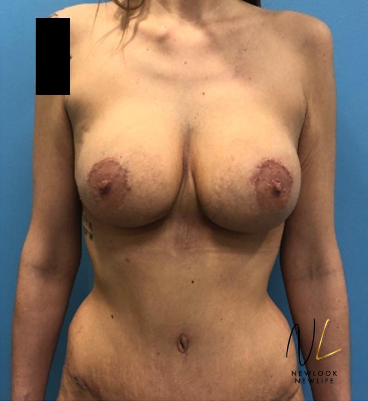 Abdominoplasty: Patient 31 - After 1