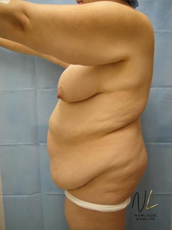 Abdominoplasty: Patient 12 - Before 2