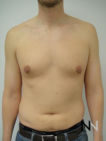 Gynecomastia: Patient 4 - After Image 1