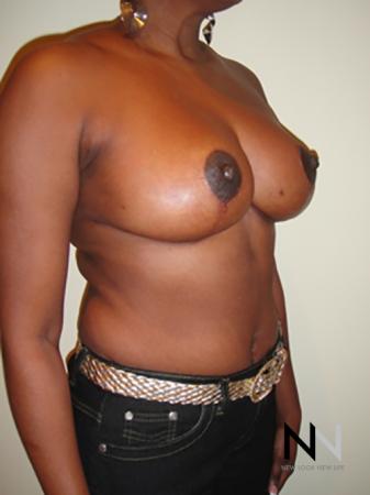 Breast Reduction: Patient 5 - After Image 3