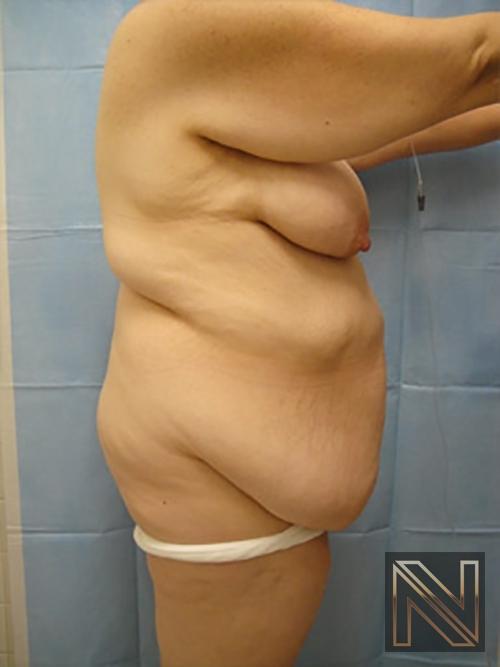 Abdominoplasty: Patient 12 - Before and After 3