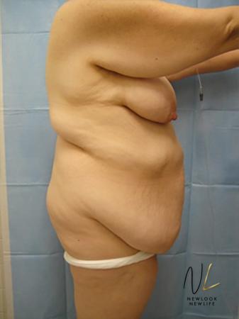 Abdominoplasty: Patient 12 - Before and After 3