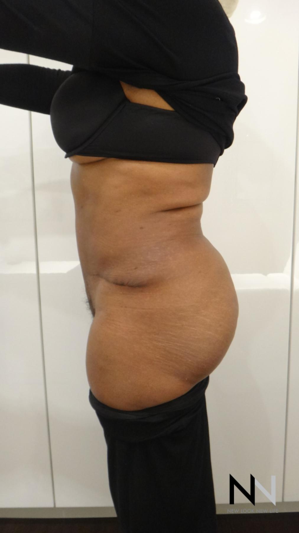 Abdominoplasty: Patient 22 - After 2