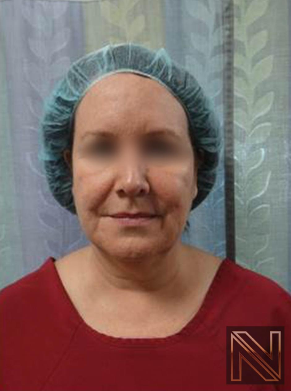 Facelift/Mini Facelift: Patient 4 - Before and After 2