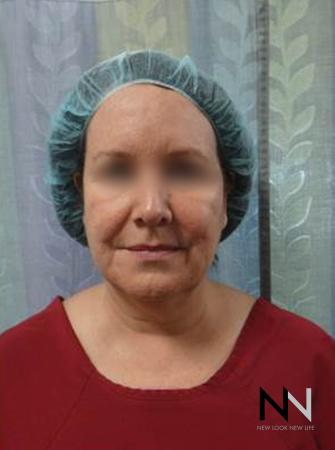 Facelift/Mini Facelift: Patient 4 - Before and After Image 2
