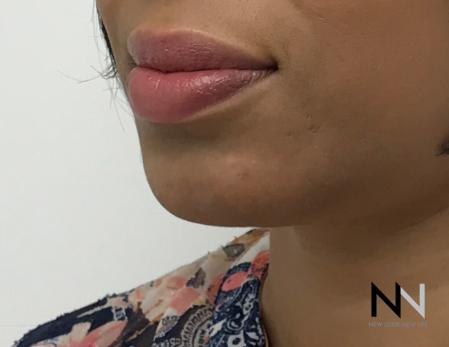 Chin Augmentation: Patient 3 - After Image 2