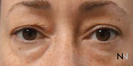 Blepharoplasty: Patient 8 - Before Image 1