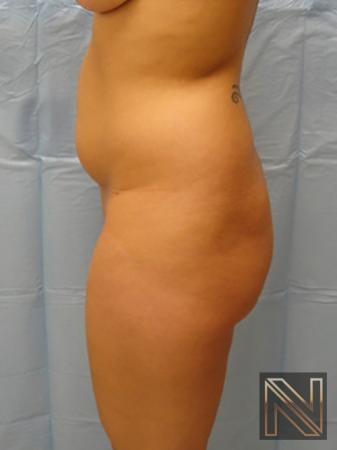 Butt Augmentation: Patient 1 - Before 