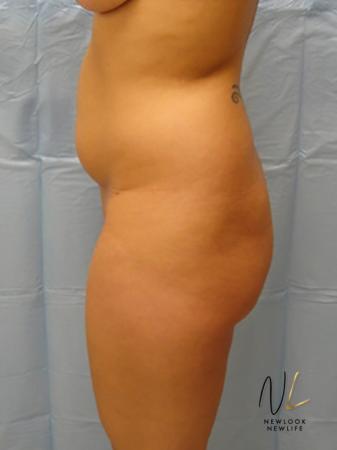 Butt Augmentation: Patient 1 - Before Image 1