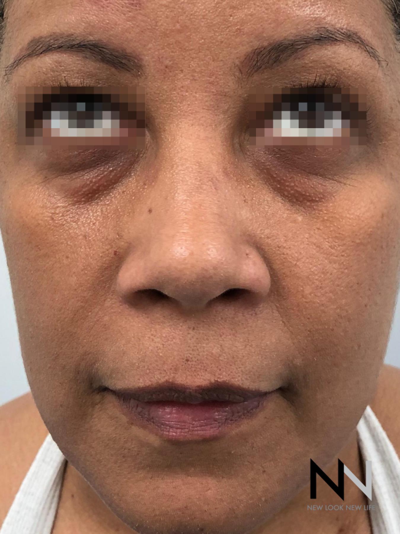 Fractional Resurfacing: Patient 6 - Before 1