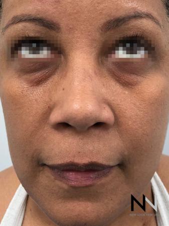 Fractional Resurfacing: Patient 6 - Before Image 1
