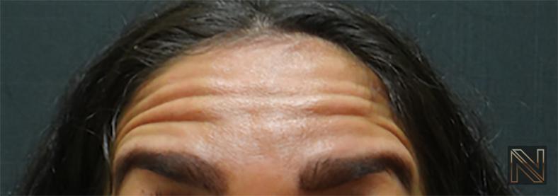 BOTOX® Cosmetic: Patient 3 - Before 1