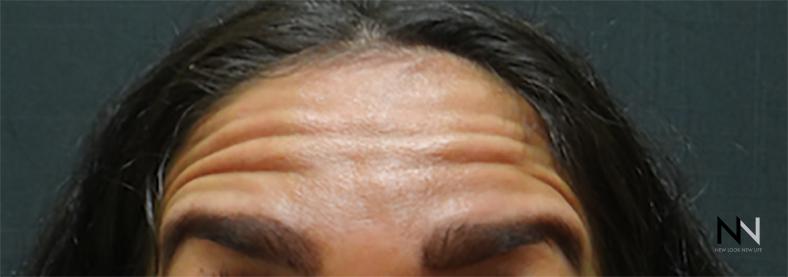 BOTOX® Cosmetic: Patient 3 - Before 