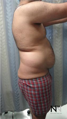 Liposuction: Patient 16 - Before and After Image 3
