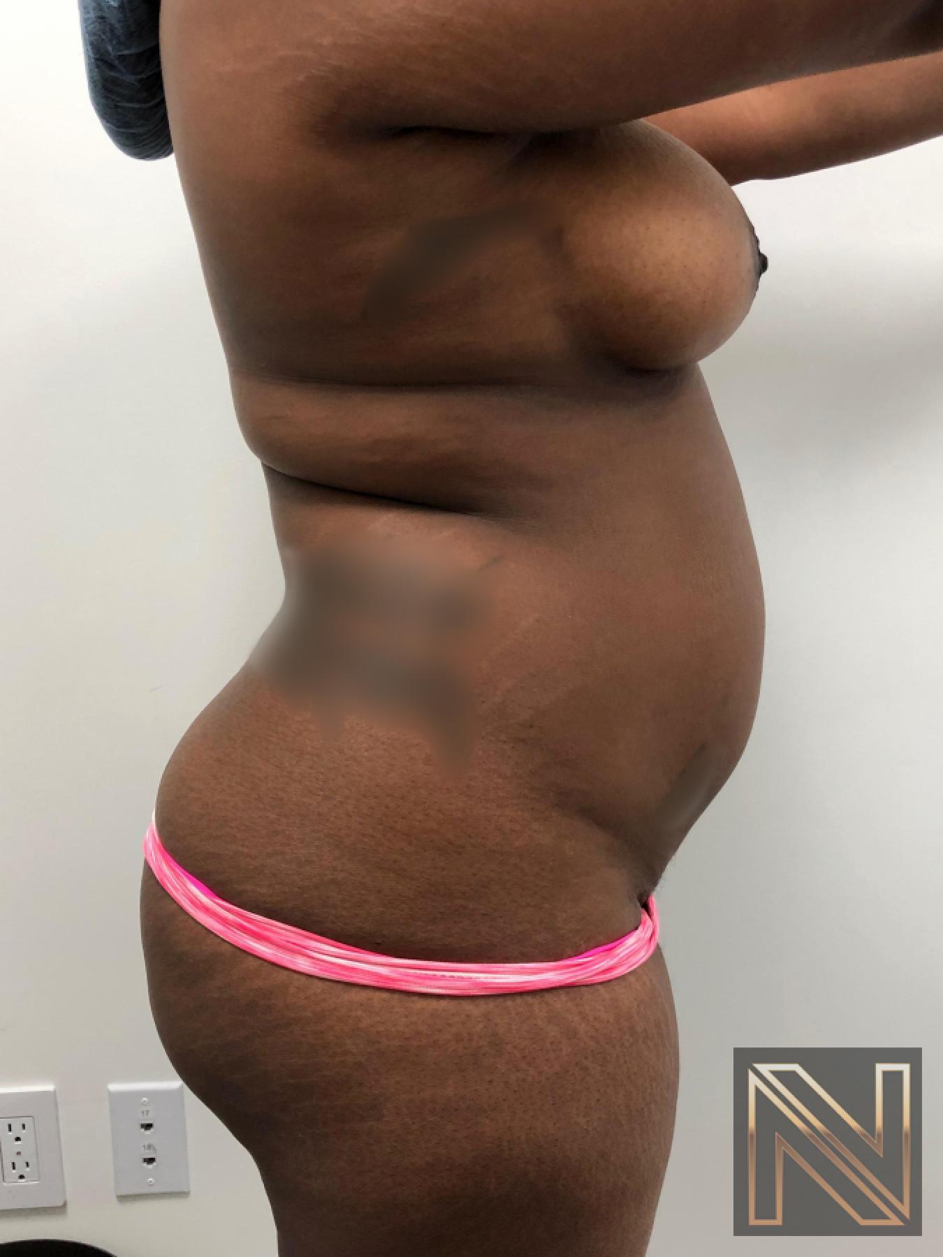 Liposuction: Patient 3 - Before and After 3