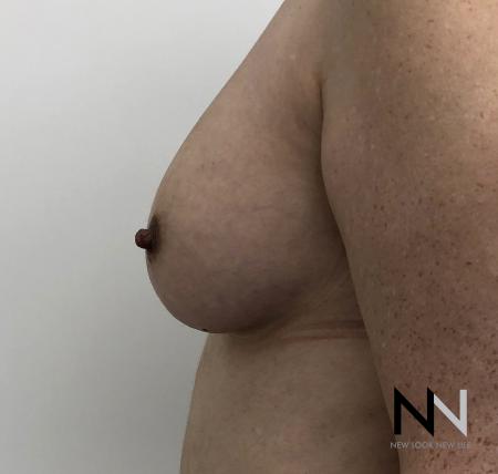 Fat Transfer - Body: Patient 2 - After Image 4