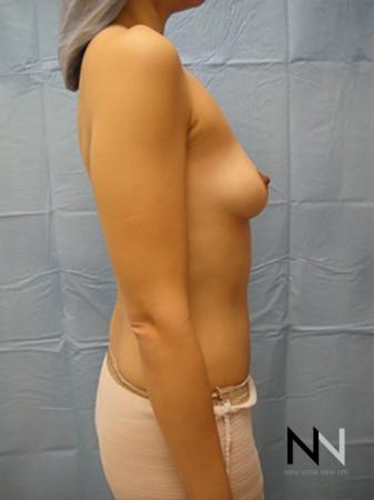 Breast Augmentation: Patient 13 - Before and After Image 5