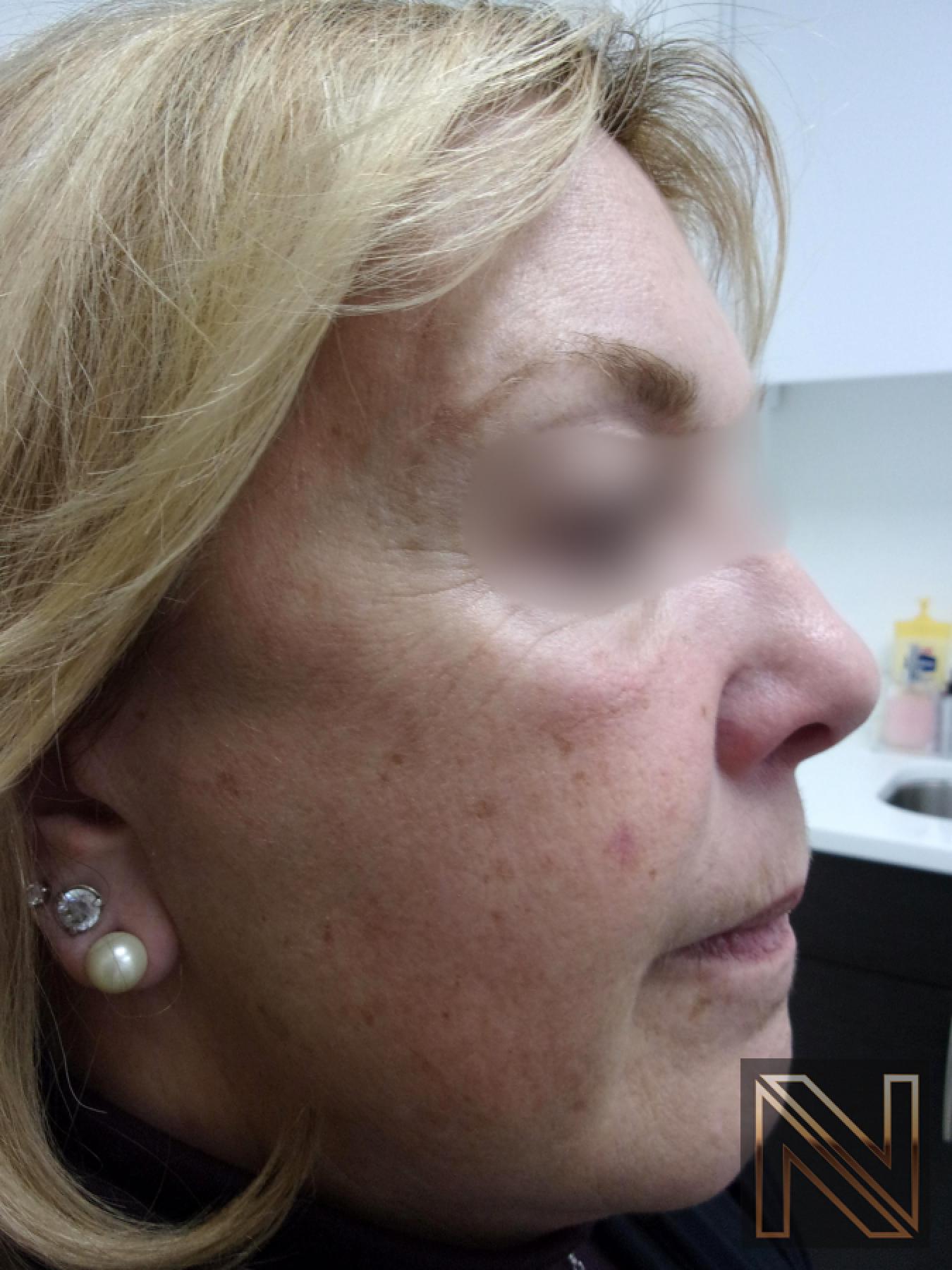 Laser Skin Resurfacing - Face: Patient 1 - Before 1