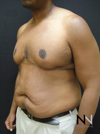Gynecomastia: Patient 1 - After Image 2