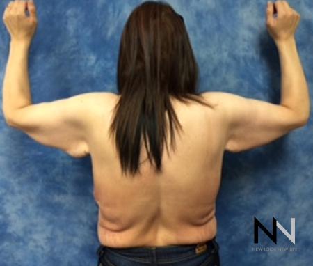 Brachioplasty: Patient 7 - Before and After Image 2