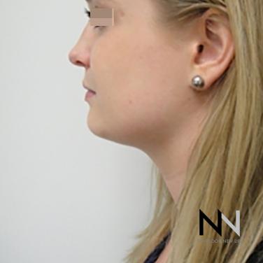 Liposuction: Patient 1 - After Image 4