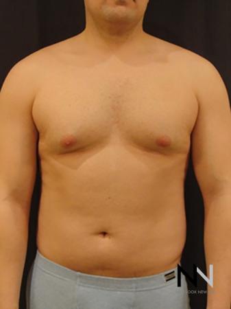 Gynecomastia: Patient 3 - Before Image 1