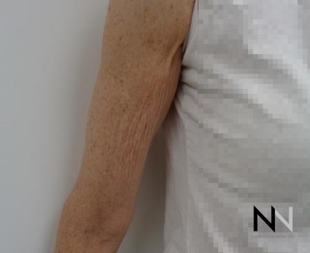 SkinTyte II™: Patient 3 - Before and After 2