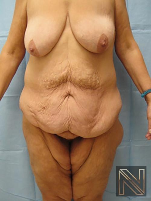 Abdominoplasty: Patient 3 - Before 1