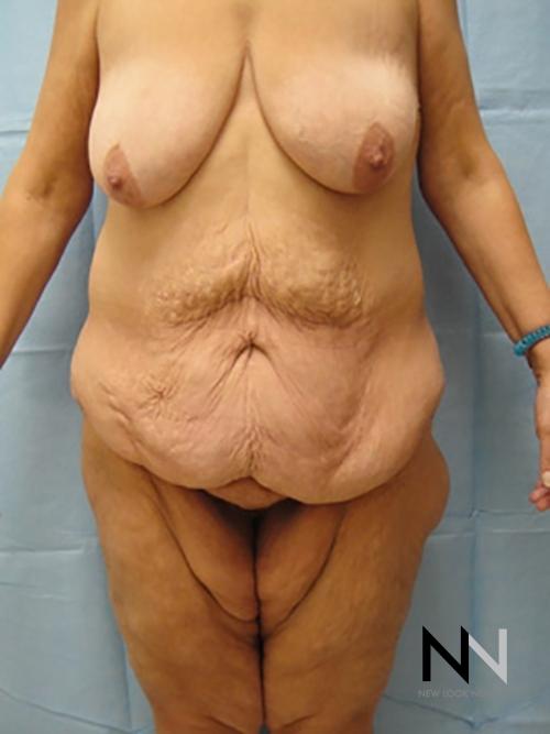 Abdominoplasty: Patient 3 - Before 1