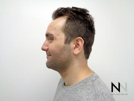 Laser Skin Resurfacing - Face: Patient 3 - After 4