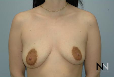 Breast Lift: Patient 15 - Before Image 1