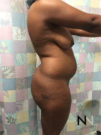 Butt Augmentation: Patient 4 - Before Image 3