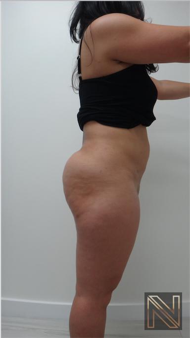 Liposuction: Patient 15 - After 2