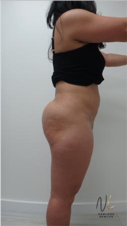 Liposuction: Patient 15 - After Image 2