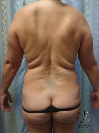 Liposuction: Patient 21 - Before Image 1