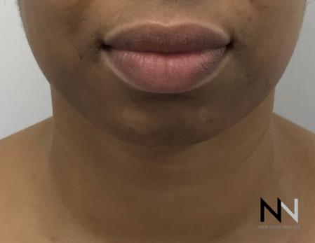 Chin Augmentation: Patient 3 - Before Image 3