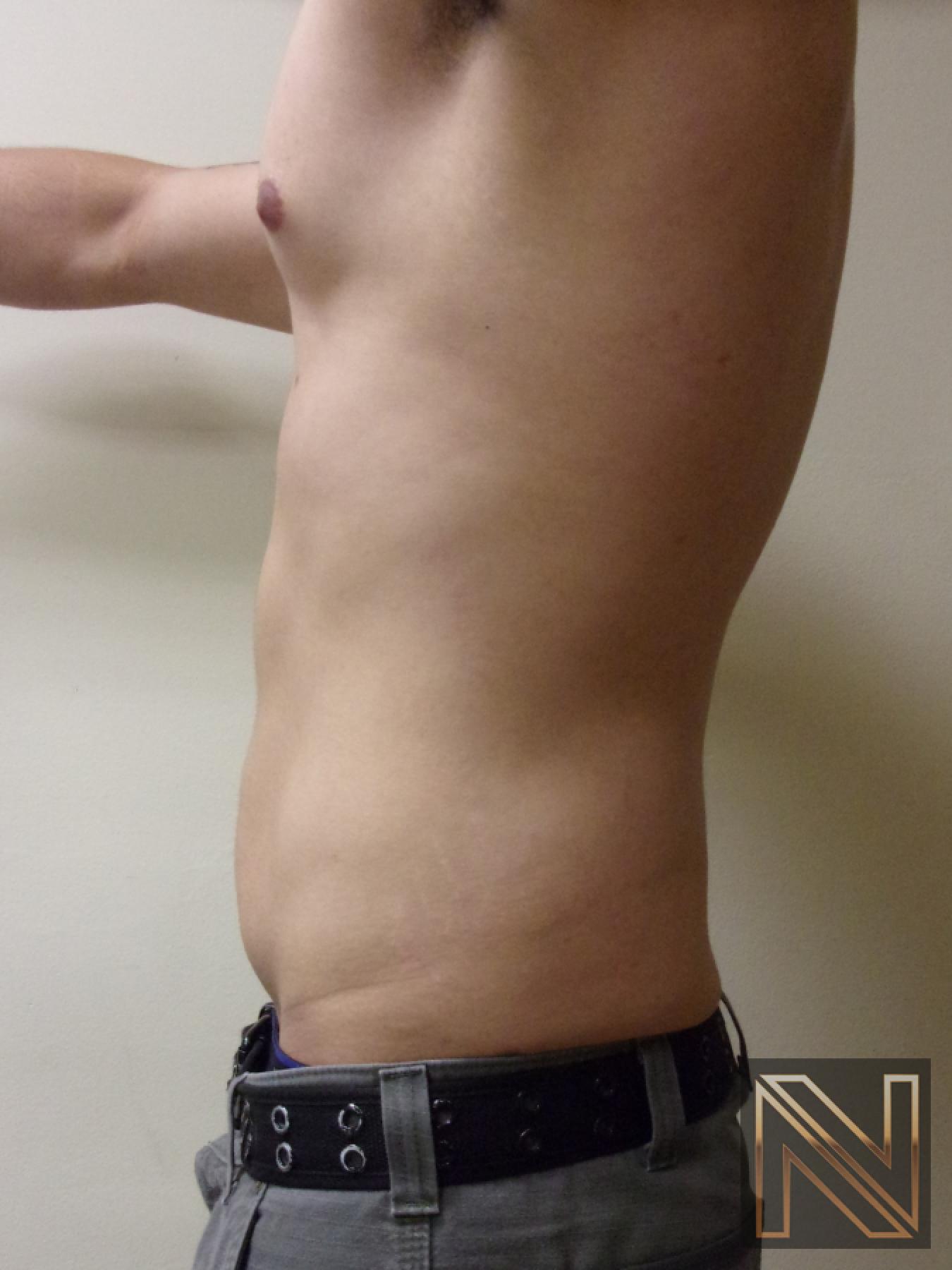 Liposuction: Patient 14 - After 2