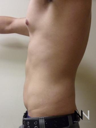 Liposuction: Patient 14 - After Image 2
