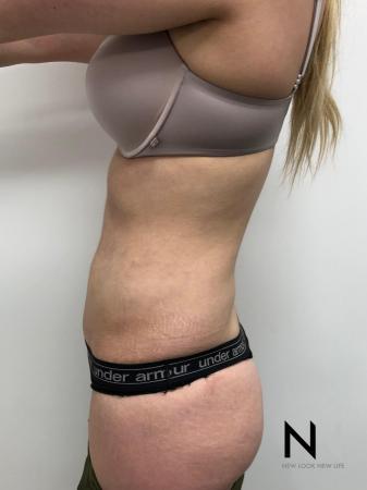 Liposuction: Patient 10 - After Image 3