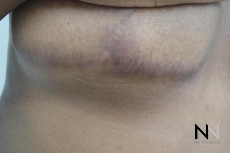 Fractional Resurfacing: Patient 9 - After Image 2