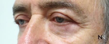 Blepharoplasty: Patient 7 - After Image 1