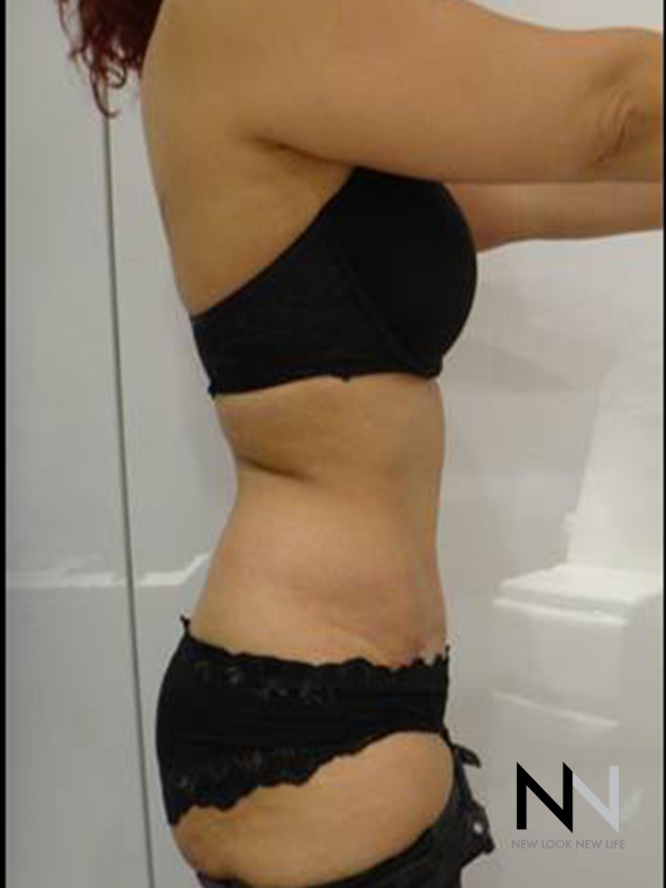 Abdominoplasty: Patient 25 - After 2