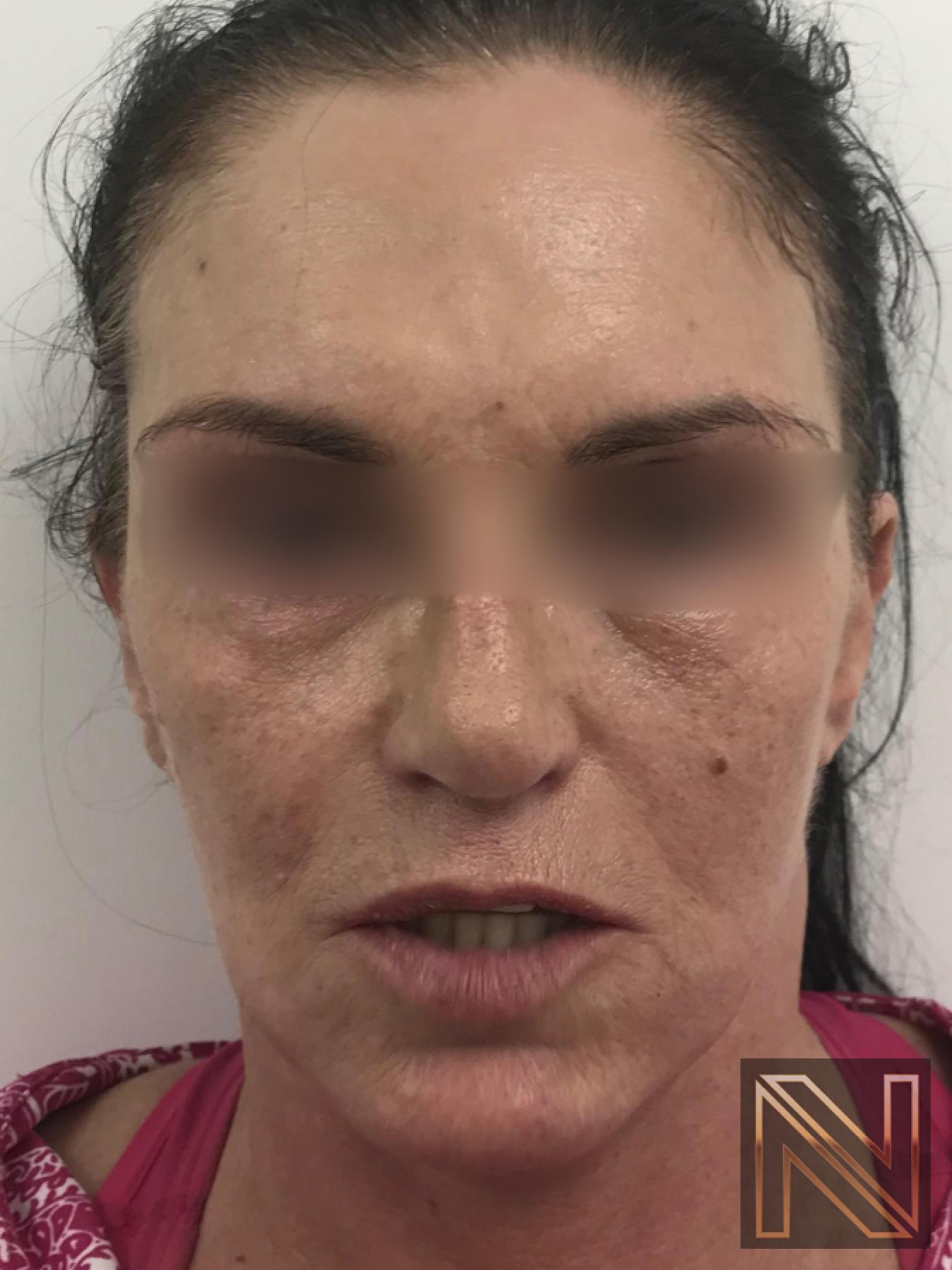 Fractional Resurfacing: Patient 1 - Before and After 3