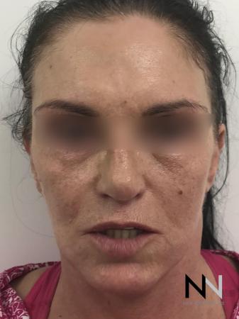 Fractional Resurfacing: Patient 1 - Before and After Image 3