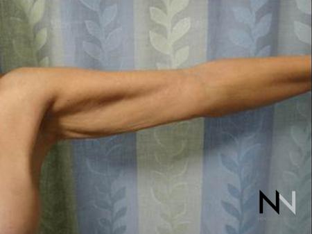 Brachioplasty: Patient 8 - Before and After Image 2