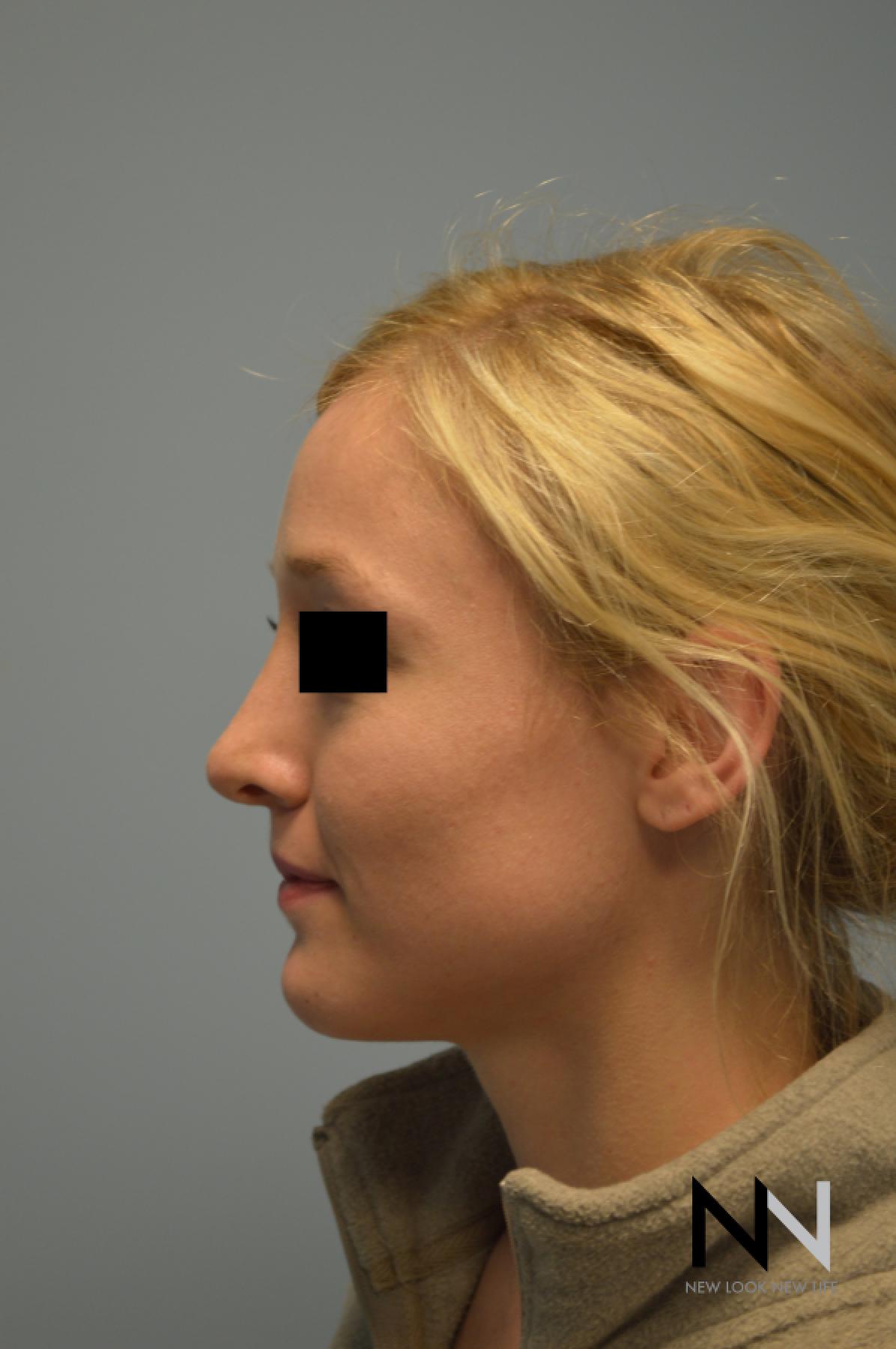 Rhinoplasty: Patient 1 - After 1