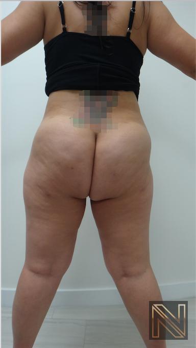 Liposuction: Patient 15 - After 4