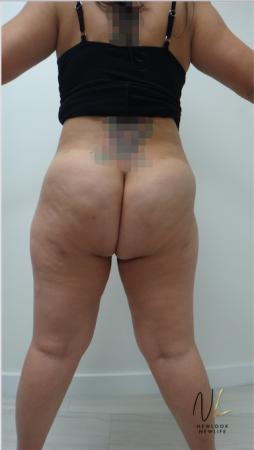 Liposuction: Patient 15 - After Image 4