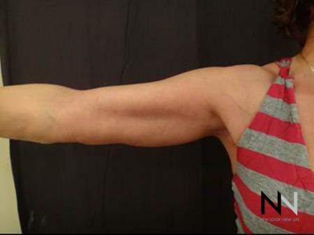 Brachioplasty: Patient 8 - After Image 1